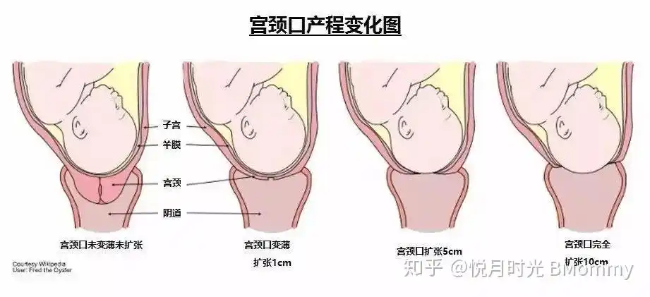 从而促进扩张,当真正宫缩来临时,宫缩会促进宫颈管变短,也开始变薄