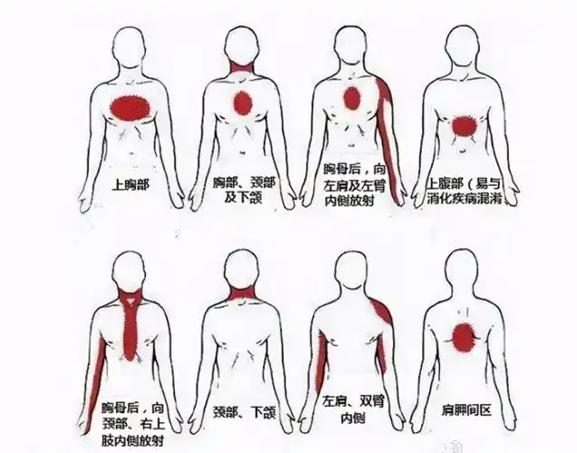 59岁男子多次心梗前兆未重视5点心脏停跳科普心梗前兆