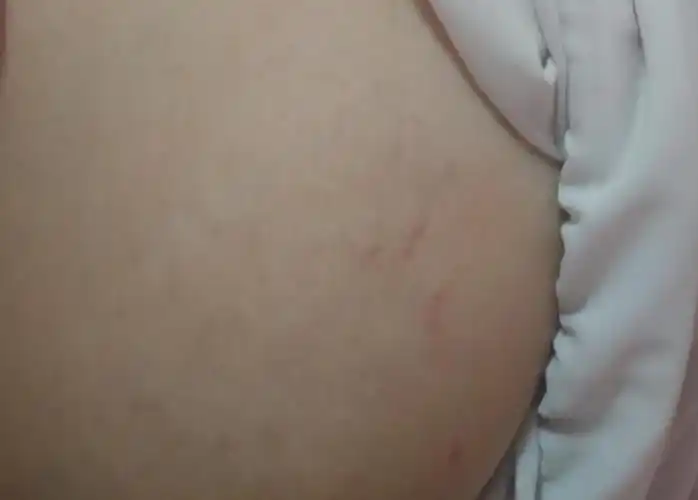 应该是生长纹怎么办啊怎么消除怎么防止它进一步变多或者变长0101