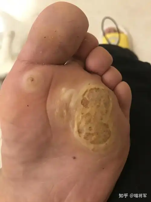 下面是使用那些淘宝药水时候的照片还有另外一款我找不到购买记录了