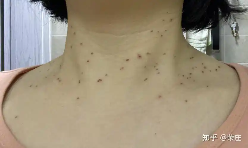 丝状疣治疗记录