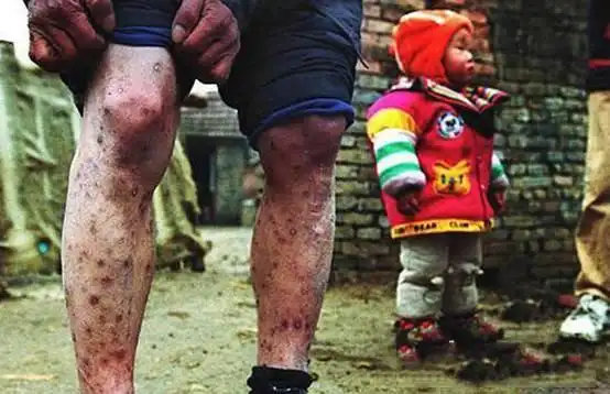 看艾滋病患者如何一步步走向死亡最后一张看了令人绝望