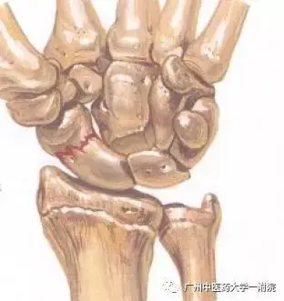 【筋骨堂】手腕部鼻烟窝压痛,警惕手舟骨骨折