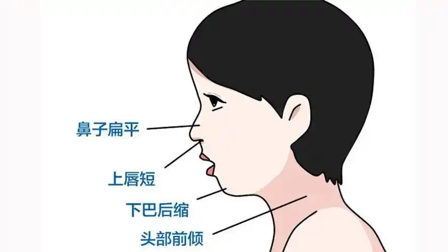 如何判断小朋友是不是"腺样体面容"?_小孩_嘴唇_方式