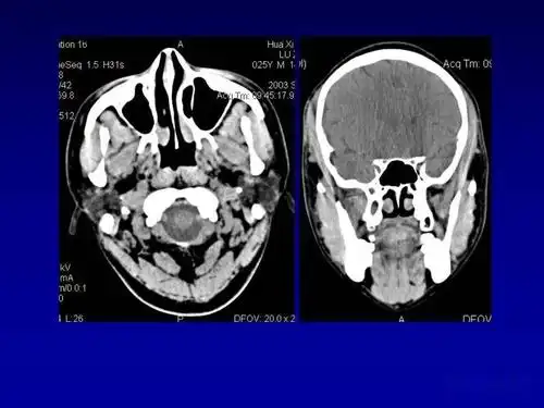 颌面部解剖及其病变的影像诊断