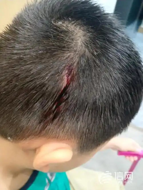 孩子洗澡时摔伤头部 伍佰青少年游泳:建议做鉴定