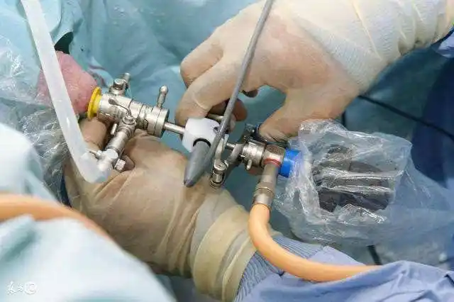 做膀胱镜检查,到底有多难受?_患者_尿道_过程