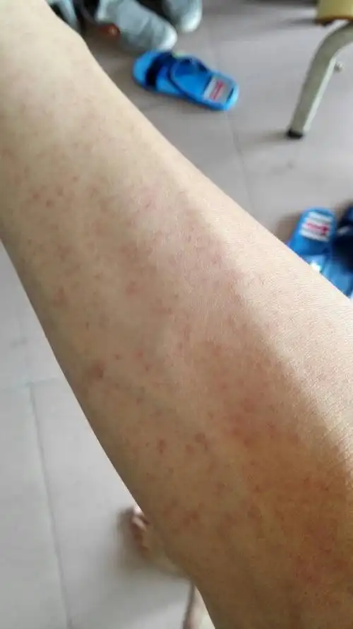 但是不怎么痒.我想问一下我这是怎么了?该吃什么药才好.