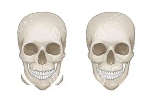 方脸只能削骨吗no快来看不削骨改善下颌骨宽大的方法