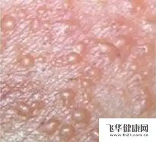 广州男科医院院长梁坚:解析生殖器疱疹的防治-精准抗艾-互联网艾滋病