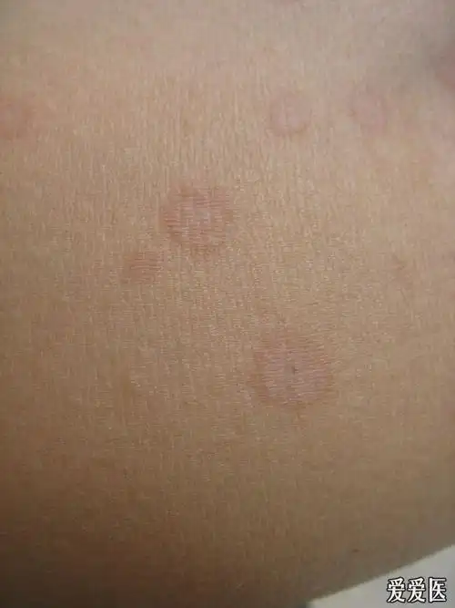 这个皮肤病是花斑癣吗