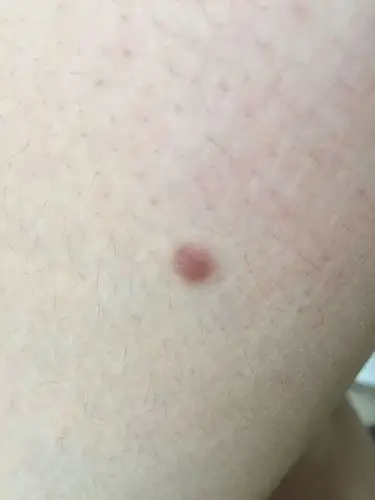 大腿外侧有硬疙瘩 左腿右腿都各有一个 好几年了 不痛不痒 什么情况?