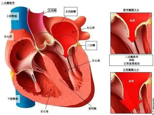 近日,潍坊市中医院心外科团队成功为一位58岁患有二尖瓣脱垂并反流(重