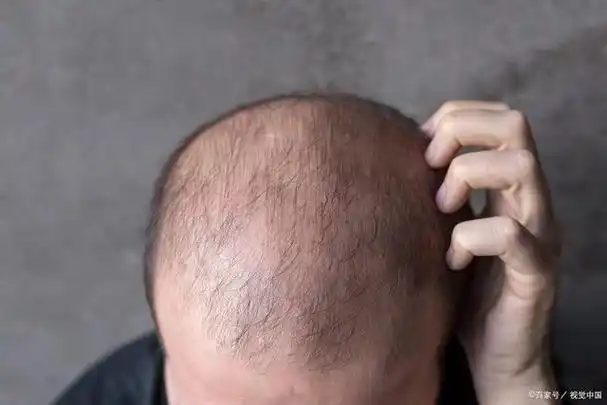 是否有秃顶基因?可以预防吗?