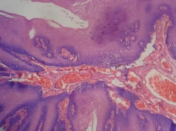 悬雍垂乳头状瘤?