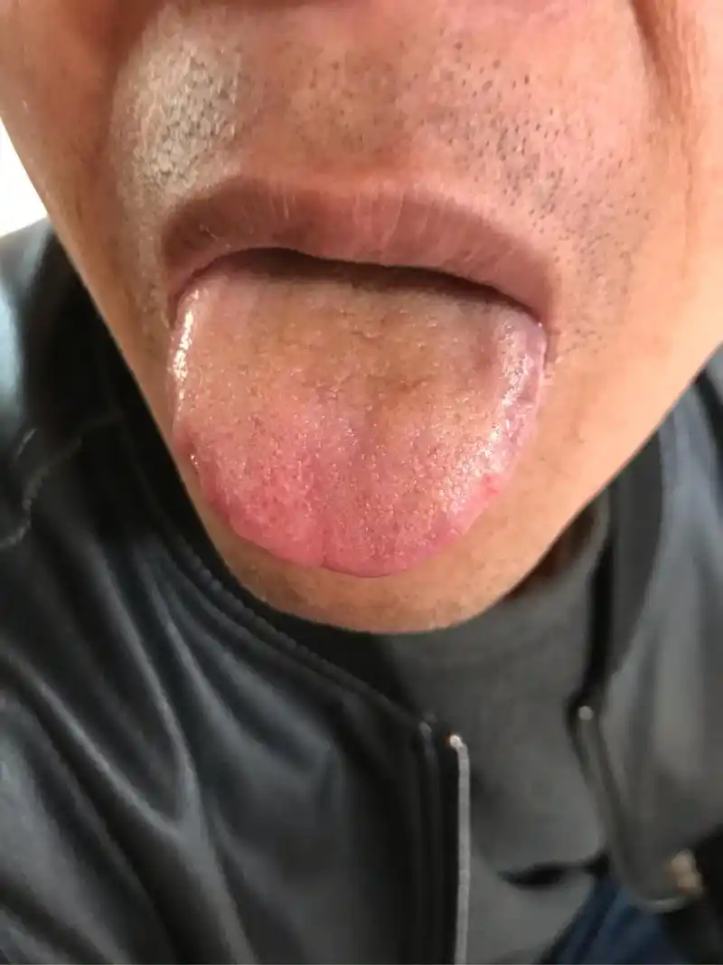 湿寒的问题消除舌苔白厚的现象也就不会有了也可服用中成药参苓白术散