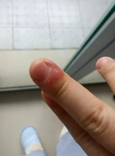 我的右手指红肿,但不痛不疼不痒,问医生有的说冻疮或红肿.