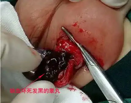 蛋肿大疼是怎么回事(一个睾丸突然肿大了怎么处理) - 达人男性屋