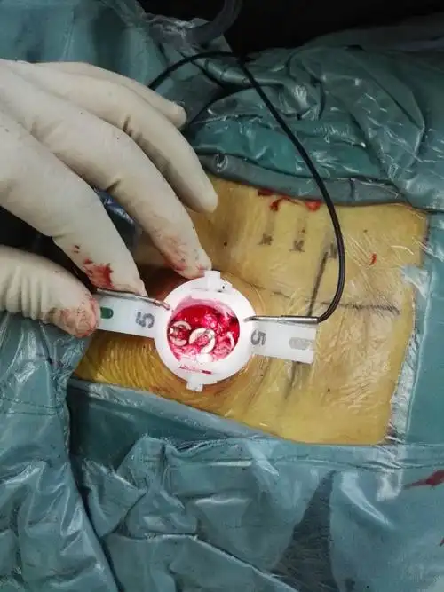 脊柱微创通道下双节段减压融合固定(mis-tlif)治疗腰椎间盘突出,腰椎