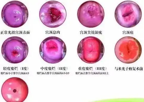 女性可怕的宫颈病变炎症糜烂囊肿息肉肥大防大于治呀