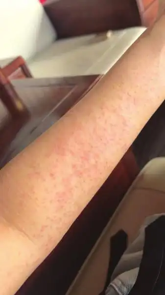 住酒店后四肢长满红疹医生诊断为屋尘螨过敏,酒店不认可