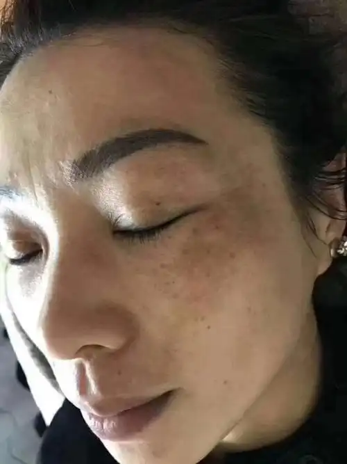 生完小孩以后出现的妊娠斑会留到很久吗