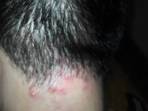 今年30岁了,怎么还有这个痘痘越来越严重,又痒又剧痛,越来越多