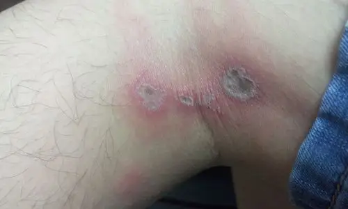 肌肉皮肤科外科 不知道被什么虫子咬了,第二天发现起水泡了,肌肉里面