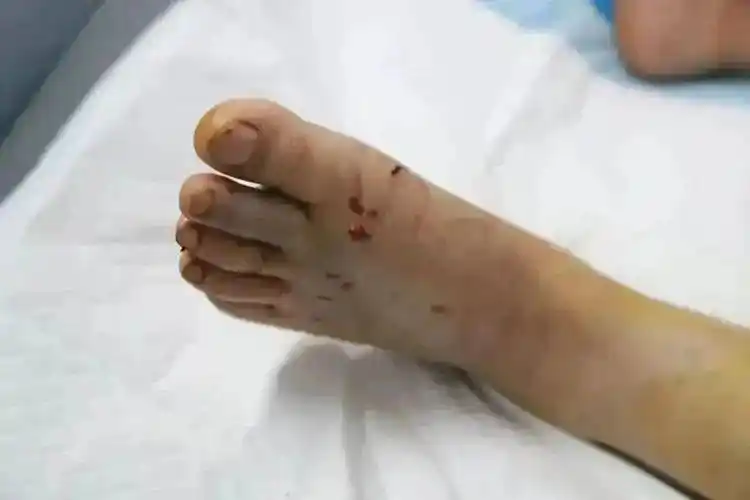 丈夫见状,意识到可能是被蛇咬了,赶紧用木棍把蛇挑到一边,把刘阿姨扶