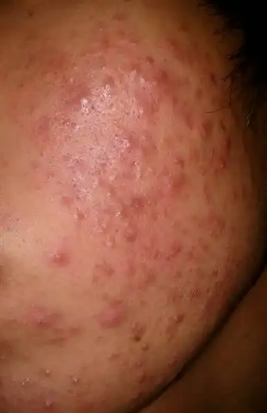 问:我这是毛囊炎还是青春痘?