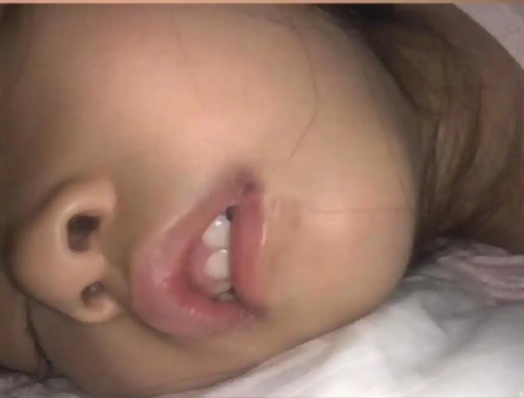 孩子出现腺样体肥大的症状主要表现在耳部,鼻部,咽喉以及全身症状.