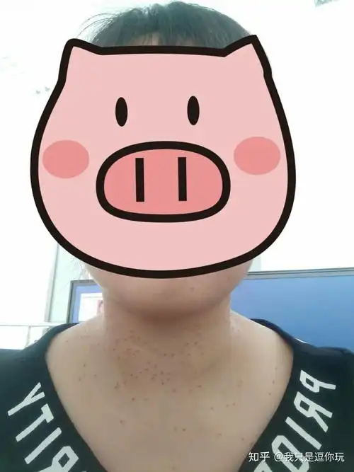 丝状疣,脖子上,女性,医生说要激光扫,有别的办法吗?