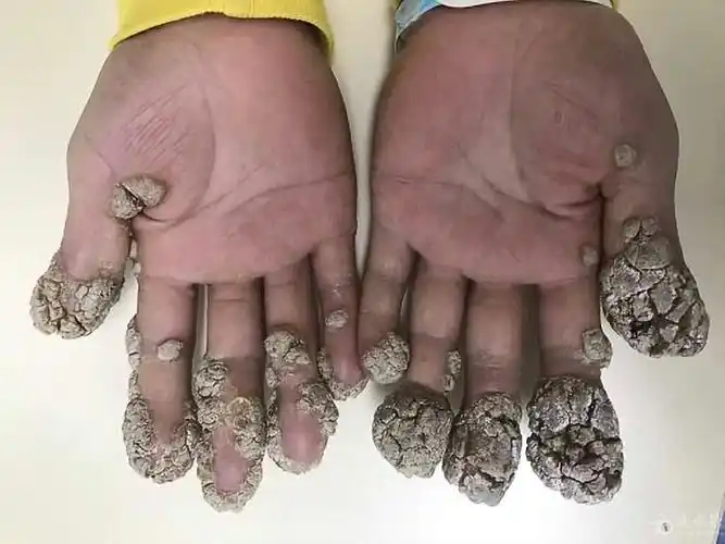 有奖猜图,积分大派送——264 疣状表皮发育不良