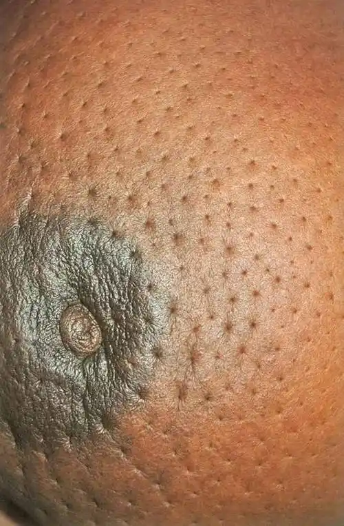 乳腺癌累及乳房浅淋巴管网时,可导致所属范围的淋巴回流受阻,发生淋巴