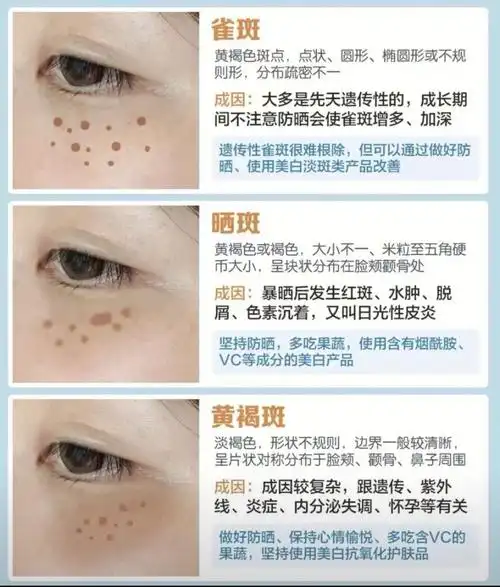 到底是晒斑还是雀斑7171466张图片教你辨别