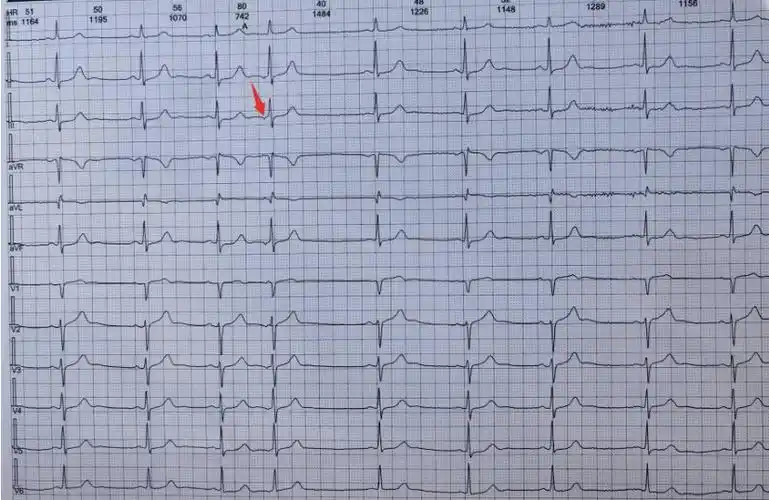呈逆行 p 波,与交界性早搏的鉴别点主要 起源于心室者,由于距离心室