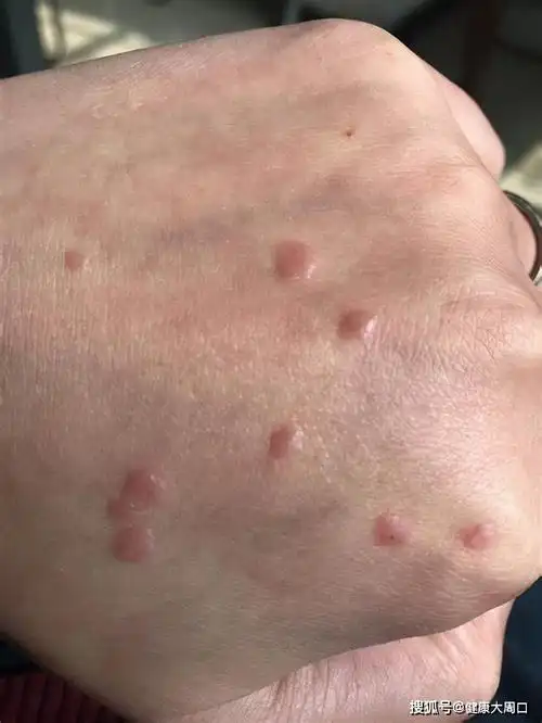 需要治疗吗?可能是hpv感染_皮肤