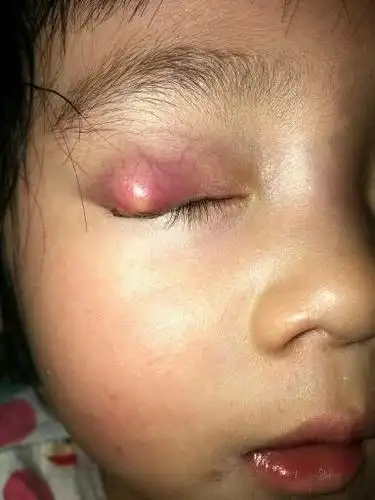 宝宝左眼下眼皮起了霰粒肿,已经一个多月了,有没有谁有经验,给点意见