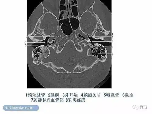 挑灯难找的影像经典最全颞骨详细ct解剖