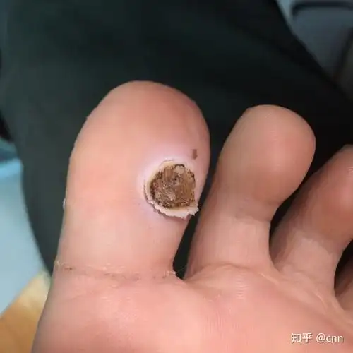 两个月治愈跖疣报告