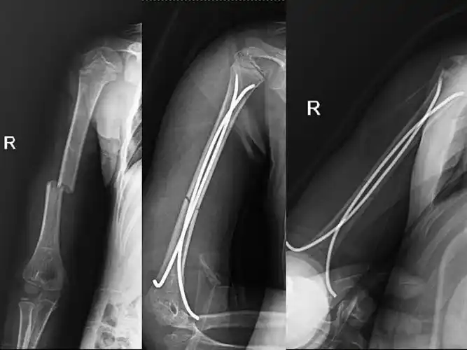 右肱骨髁上轻微骨折 右侧肱骨内上髁骨折-图片大观-奇异网