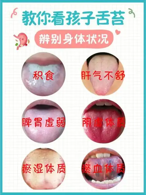 教你看孩子舌苔判断孩子身体状况