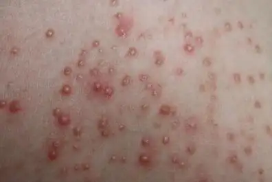 【艾生活】背后长很多"小米粒"到底是什么情况?