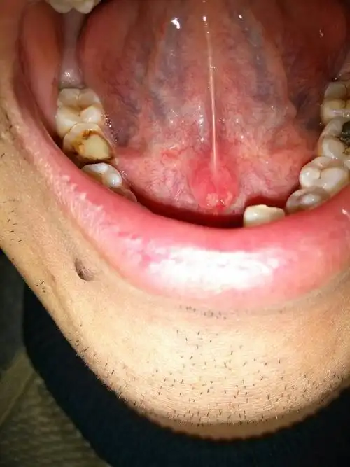 感觉舌头下面很不舒服,对着镜子照了以后,发现舌头下面有两个白黄色的