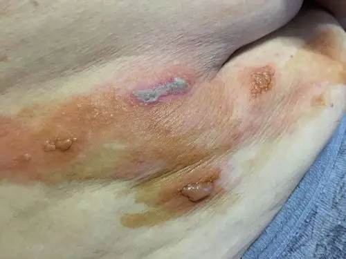 奶奶胸部以下长了这样的疙瘩,连续的小泡是刚开始长的,大水泡是中期