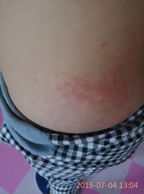 几个月前身上起这个红疙瘩 痒死了 因为怀孕没敢上药 这几天有出来了