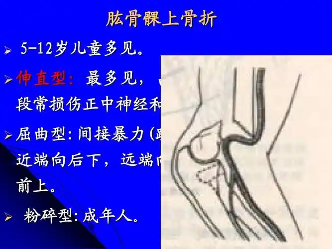 无忧文档 所有分类 自然科学 化学 第二节 四肢骨折ppt 肱骨髁上骨折