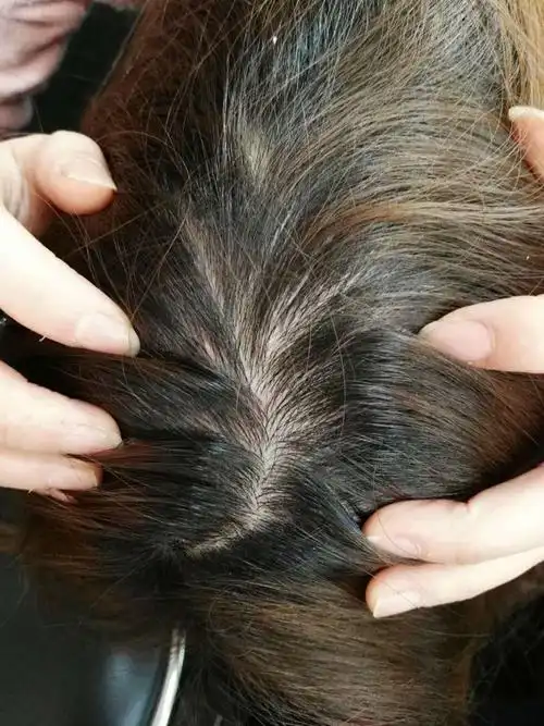 我的头上长了红色痘痘,有痒又痛,请问这是怎么了