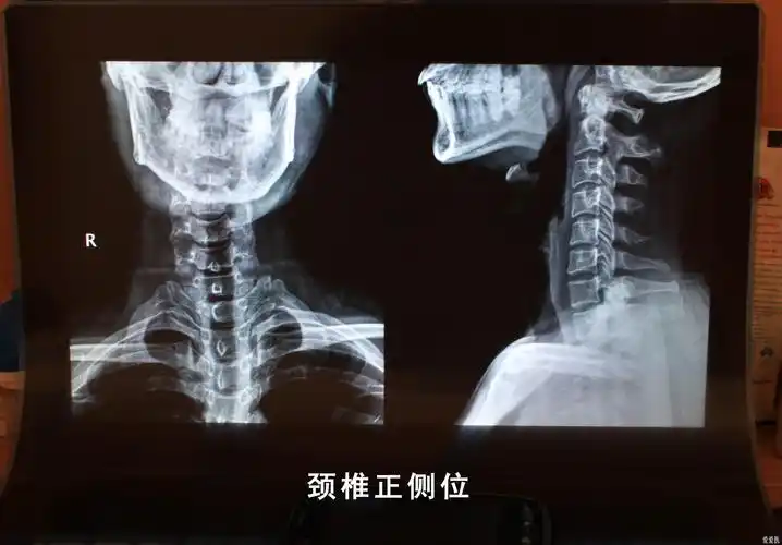 颈椎图片求解谢谢