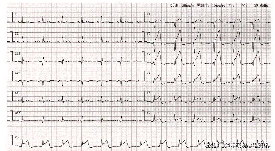 患者男,65岁,因突发剧烈胸痛来医院就诊,图为其体检心电图